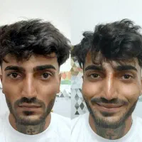 تزریق ژل و بوتاکس به صورت تخصصی