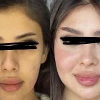 تزریق ژل فول فیس سی سی ۶۹۹|خدمات آرایشگری و زیبایی|اصفهان, خانه اصفهان|دیوار