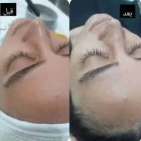 لیزر موهای زائد لیزر مو فشیال پاکسازی پوست|خدمات آرایشگری و زیبایی|تهران, فلسطین (میدان انقلاب)|دیوار