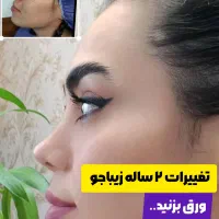 جشنواره تخفیف عمل زیبایی بینی