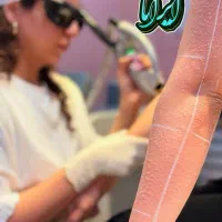 تخفیف یلدانه کندلاموی زائد۲۰۲۵ (کلینیک ایرانا)