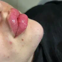 ژل،بوتاکس،مزو،چال لپ،فیلر|خدمات آرایشگری و زیبایی|قم, عمار یاسر|دیوار