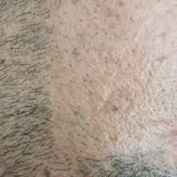 جشنواره پاییزی لیزر.لاغری.کرایو.ژل.آراف