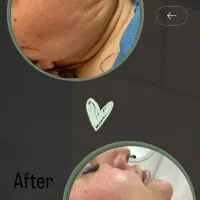 جشنواره تخفیفی تزریقات،کربن، ژل و بوتاکس،لیزر|خدمات آرایشگری و زیبایی|بندرعباس, |دیوار