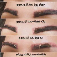 ریموو تخصصی تاتو ۵۰٪تخفیف روز مادر برای ۲۰ نفر اول|خدمات آرایشگری و زیبایی|مشهد, سجاد شهر|دیوار