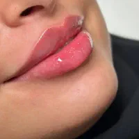 ۵۰٪ ژل بوتاکس فیلر مزو توسط دکتر کلینیک زیبایی مطب