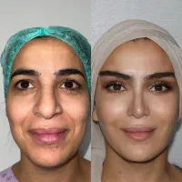 جراحی عمل بینی۳۷ میلیونی اقساطی بدون پیش پرداخت