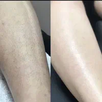 جشنواره لیزر رایگان فقط تا پنج شنبه/تضمینی/ لاله|خدمات آرایشگری و زیبایی|اصفهان, باتون|دیوار