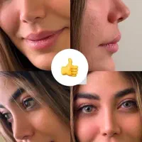 عمل جراحی بینی با پیزو فقط24/ ترمیم/مشاوره رایگان