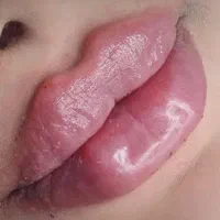 تزریق ژل و بوتاکس