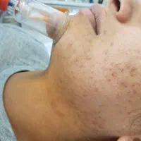 حجامت با لوازم کاملاً بهداشت و یکبار مصرف در مرکز