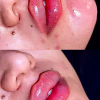 ژل و بوتاکس و مزو صورت و موو نخ