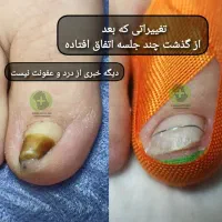 درمان ناخن فرورفته درگوشت بدون جراحی در کلینیک|خدمات آرایشگری و زیبایی|ورامین, خیر آباد|دیوار