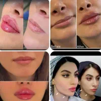 جشنواره یلدایی ژل لب کانتورینگ مزوژل لیفت صورت|خدمات آرایشگری و زیبایی|تهران, تهرانپارس جنوبی|دیوار