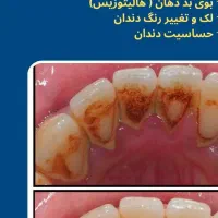جرم گیری دندان با تعرفه دولتی تحت پوشش بیمه|آرایشی، بهداشتی، درمانی|اصفهان, دهنو|دیوار