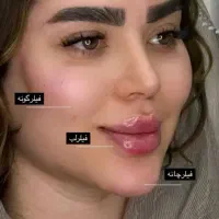 جشنواره زیبایی((ژل وبوتاکس))به مناسبت یلدا