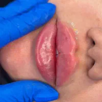 تزریق ژل و بوتاکس تضمینی|خدمات آرایشگری و زیبایی|قرچک, مهدیه|دیوار