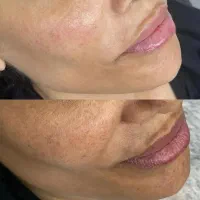 آموزش و ارائه خدمات تخصصی پاکسازی پوست، کربوکسی و.