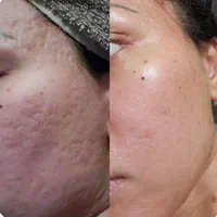 مدل فیشیالcip با دستگاه آنالیز دار و هوش مصنوعی|خدمات آرایشگری و زیبایی|کرج, گلشهر|دیوار