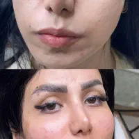 تزریق فیلر و بوتاکس(تخفیفمونو از دست نده)|خدمات آرایشگری و زیبایی|شهریار, شهرک وائین|دیوار