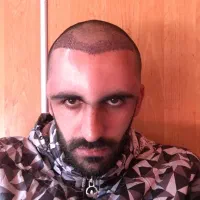 کاشت مو تنها با ۱۵ میلیون تومان|خدمات آرایشگری و زیبایی|بومهن, |دیوار