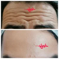 تزریق فیلر ژل و بوتاکس در کلینیک|خدمات آرایشگری و زیبایی|بندرعباس, |دیوار