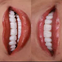 دندانپزشکی نگارام مجهزترین دندانپزشکی قم|خدمات زیبایی و سلامت|قم, بکایی|دیوار