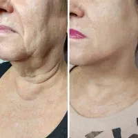 هایفو HIFU لیفت و جوان‌سازی پوست بدون جراحی