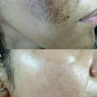 تزریق فیلر و بوتاکس اقساط توسط پزشک در مطب|خدمات آرایشگری و زیبایی|خرمشهر, |دیوار