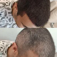 آموزش و خدمات میکرواسکالپ مکمل کاشت مو|خدمات آرایشگری و زیبایی|تهران, الهیه|دیوار