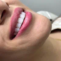 انجام کامپوزیت ونیر با بهترین متریال با افر ۶۰٪|خدمات آرایشگری و زیبایی|بابل, |دیوار