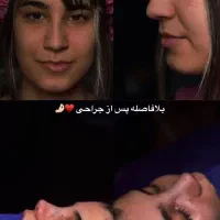 آف ویژه زیبایی بینی و لیپو ابدو|خدمات زیبایی و سلامت|اهواز, کیانپارس |دیوار