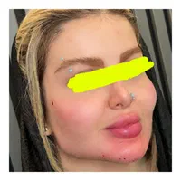 لب روسی پروفیس .جوانسازی.  پزشک