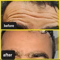 نیازمند مدل بوتاکس و ژل.اموزش ژل و بوتاکس|خدمات آرایشگری و زیبایی|صدرا-فارس, فاز ۱|دیوار