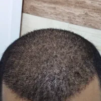 کاشت مو به روش میکرو FIT و میکروSUT