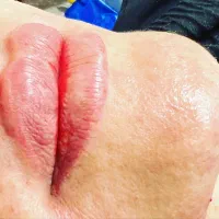 آموزش و تزریق ژل و بوتاکس مزوتراپی پی آرپی..