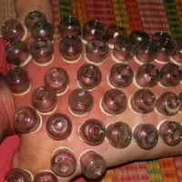 آموزش حجامت زالو درمانی و