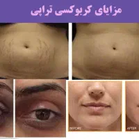 کربوکسی تراپی با دستگاه مخصوص
