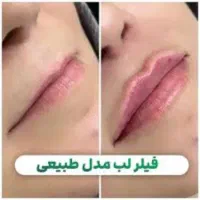 جشنواره تززیق فیلر،ژل وبوتاکس درهفده شهریور|خدمات آرایشگری و زیبایی|تبریز, |دیوار