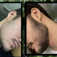 احیای مو. ترکیبی موثر