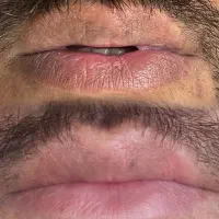 رفع تیرگی دائمی لب (فقط آقایان)|خدمات آرایشگری و زیبایی|اهواز, سپیدار|دیوار