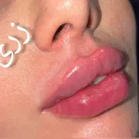 تزریق ژل و بوتاکس