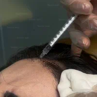 مزوتراپی تخصصی تقویت و رشد مو PRP و هیرفیلر