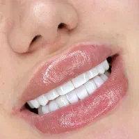 مدل کامپوزیت دندان|خدمات آرایشگری و زیبایی|تهران, هاشمی|دیوار