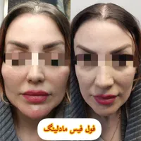 جشنواره تخفیف بوتاکس/ژل/آنزیم‌بینی/فیلرلب/فولفیس|خدمات آرایشگری و زیبایی|شیراز, زرهی|دیوار