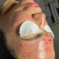 خالبرداری ،رفع کک ومک ،برداشتن میخچه توسط پزشک|خدمات آرایشگری و زیبایی|کرج, شهرک یاس جنوبی|دیوار