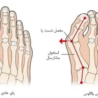 مرکز تخصصی درمان هالوکس والگوس (شست پای کج)