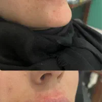 بوتاکس/فیلر با تخفیف ویژه توسط پزشک