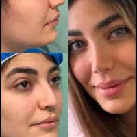 عمل جراحی بینی 40%تخفیف (رینوپلاستی)در کرج