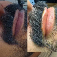 رفع کبودی لب مخصوصا اقایان